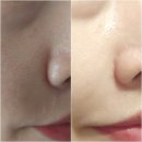 나노필의원 | 수원 저자극필링 플라필 깐달걀 물광피부 만들기