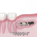 천사의눈물 | 피와 눈물로 쓰인 사랑니 발치 후기…