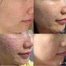 로미한의원 | 강남역피부관리, PN리빌더 T 후기, 수분 각질 여드름 케어 경험