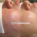 알라딘메디칼 | [공지] 알라딘필링 50%할인,1+1 등드름 페이스 이벤트 !!마감임박!!-2월28일까지 알라딘필링후기