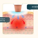 고주파 이미지