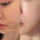 신세계의료기 | 선릉역 세르프 리프팅 600샷, 울써마지 대신 받은 7일차 내돈내산 후기 효과