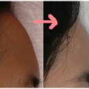 이마수술 사진 공개할게여^^