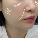 부티나 | 얼굴형 관리, 앞볼 팔자 필러 대신 스컬트라 주기적으로 받은 효과 후기