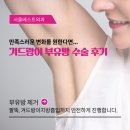 여의도아라외과의원 | 겨드랑이 부유방 수술 후기, 만족스러운 변화