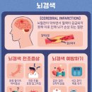 혈관 끈적끈적…여름에도 뇌경색 안심할 수 없는 이유 이미지