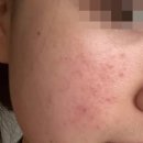 대박이 | 병풀크림 추천 환절기 트러블에 효과 대박이라 올리는 후기