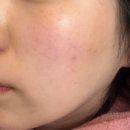 스킨패턴 | 신사역피부과 미라젯 리투오 스킨부스터로 환절기 피부관리 후기