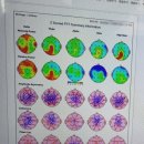李 편한마음 정신건강의학과의원 | 불면증 불안장애 우울감 극복기 2탄 !! tDCS 치료 후기 (+뇌파 결과) 이수역 정신과, 서초구 정신과...