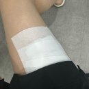 두암팔팔정형외과의원 | [블챌] 갈테야갈테야 화상병원에 갈테야