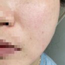 금일건강약국 | 약국 흉터 색소침착 연고 추천 내돈내산 구매후기 효과