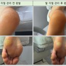 문제성 손, 발 오감네일 이미지