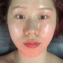 화정동피부관리 기찬뷰티 셀프로샷레이저 관리 후기 모공과 리프팅을 한번에 !