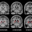 알츠하이머 치매 증상 발병하는 원인 뇌 건강을 위한 수칙 이미지
