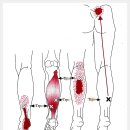 가자미근 연관통증[Soleus Referral Pain] 이미지