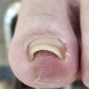 GS25배곧어반점 | 배곧내성발톱 안아픈데 효과좋은 관리샵 배곧 네일포유 골든풋 배곧점