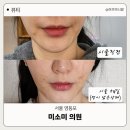 미소미 | 내돈내산 영등포피부과 미소미의원 리브이리프팅후기