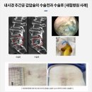 추간공확장술 분명한 나아짐 보여줄 척추협착증명의 찾았다면 이미지