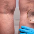 지에이치의원 | 인천에서 하지정맥류 잘 보는 병원(추천 많이 받는 곳)