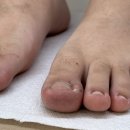 엔피케어창원 | 창원 내성발톱 고민이 싹 사라졌어요