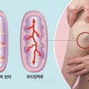 다리 무겁고 피곤하면 ‘하지정맥류’ 여부 검진을 이미지