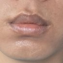 제주블랑 | [제주 핑크블랑 후기] 입술 멜라닌 케어 2회차