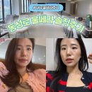 프라임성형외과 - 안산시 단원구 고잔1길 16 | 대구 성형외과 신상 울쎄라프라임 1주차 후기 (+ 이마 미간 보톡스)