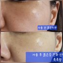 포레세