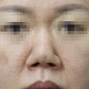 [기고/칼럼] 자가늑연골을 사용한 코수술/코재수술 - 7. 콧대 자가늑연골의 와핑과 해결