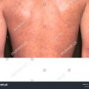 매독 환자 급증 이런 증상 즉시 검사 받으세요 여자 남자 매독 증상 피부발진 이미지