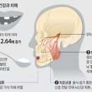 치아 없으면 감각 신경 자극 안 돼 뇌기능 퇴화 이미지