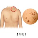 쥐젖[Soft fibroma]피부질환 이미지