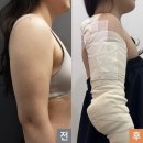 365MC의원 | [후기 2] 365mc 팔뚝 무한람스 당일 후기