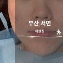 ㅣ부산 새살침 4회차 후기, 통증, 가격ㅣ붉은기 완화 레이저ㅣ여드름 흉터 관리ㅣ