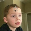 멍스타일 | 압구정 아몬드 성형외과 자연유착+눈매교정 내돈내산 당일 솔직후기 붓기 멍 비용