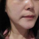 대성메디컬프라자 앞 | 수원 인계동 메디컬오, 하이푸 레이저 1회차 내돈내산 후기
