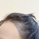 토탈세탁소 | 못생겼던 헤어라인 대신 예쁜 일자 헤어라인 생긴 후기. 인천시청역 토탈뷰티샵ㅣ탠뷰티