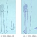 만성요통과 디스크 이미지