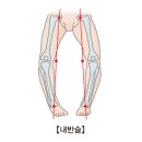 내반슬 (Bow leg) 근 골격질환이란? 이미지