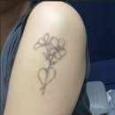 영수 | 컴포트 성형외과 문신제거 2회차 솔직후기(문신지우는 영수쌤)