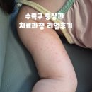 동그란어린이집 30m 경계 | 수족구증상 순서 손발 팔다리 생식기 수포와 열로 일주일만에 등원(약 처방전)
