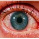 눈충혈 원인 눈이 빨개요 예방 치료 방법 이미지
