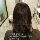 비절개모발이식 헤어라인교정 모발이식 수술 과정 이미지