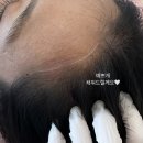 탈모왕 대구점 네이버블로그