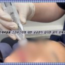 우성폴리머 | 평택쥬베룩볼륨 스킨부스터에 대한 궁금증이 있다면 읽어 보세요.