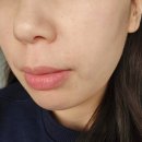 예비 신부관리 슈링크유니버스 리쥬란 운동 괄사 식단 셀프관리