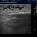 subcuteneous tissue edema 이미지