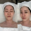 하라뷰티(Hara beauty) | 서면 피부관리 이브뷰티센터 서면점 : 트라이엄 레이저로 모공과 피부결 한번에 케어할 수 있음 !