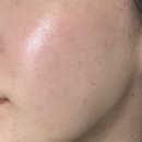 제네시스 | 내돈내산 안면 홍조 레이저 제네시스 레이저 후기