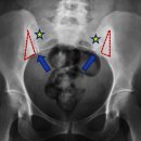 장골 | Case_Study_554:분만 후 허리 통증이 있는 32세 여성_골염 응축 장골(OCI: Osteitis condensans ilii)
